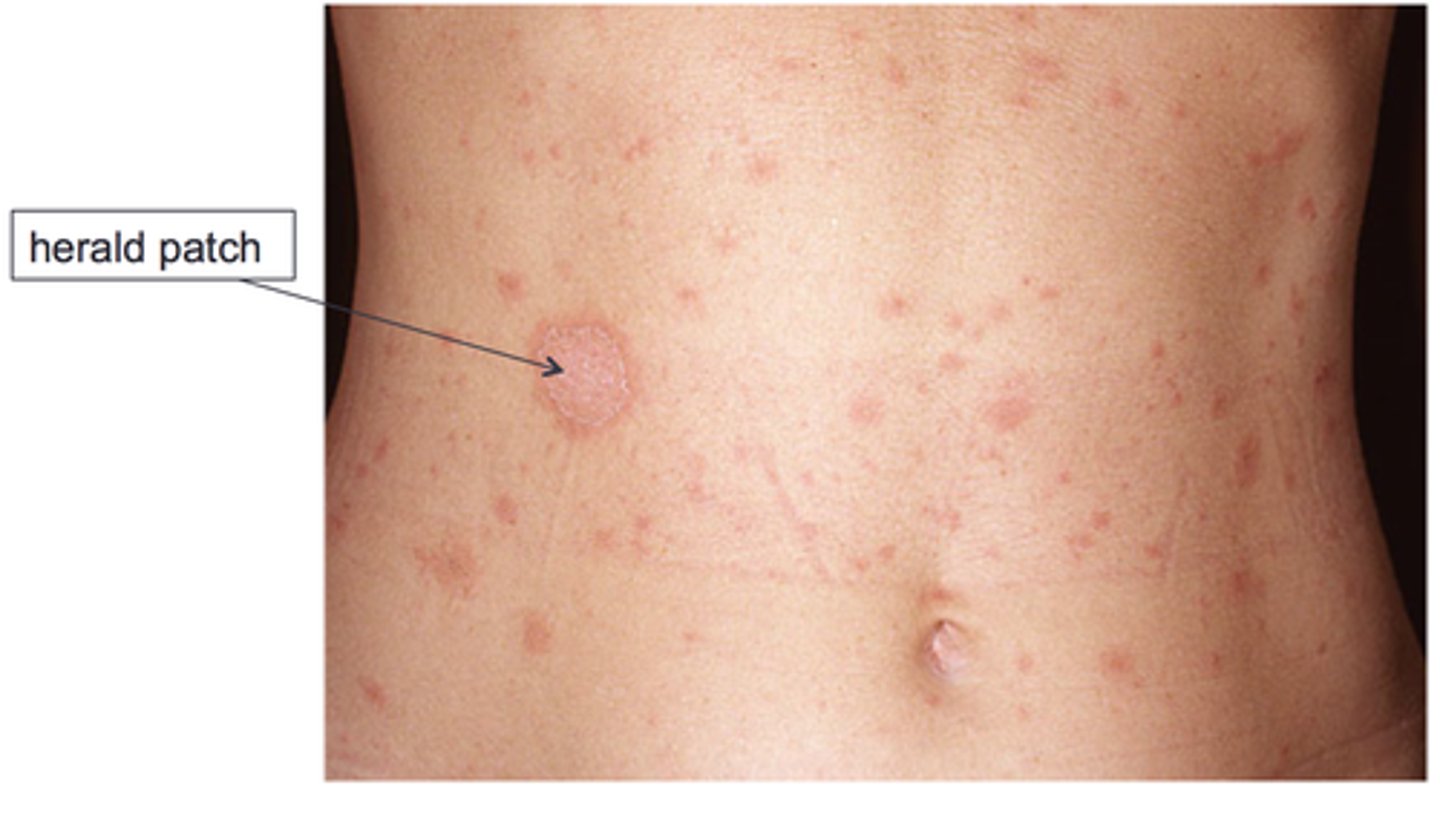 <p>Single large (2-5cm) oval salmon-colored patch with collarette scale appearing 1-2 weeks before generalized eruption</p>