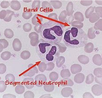 <p><span style="font-family: "Calibri Light";"><span>Neutrophil types: </span></span></p><ul><li><p><span style="font-family: "Calibri Light";"><span>bands (immature) </span></span></p></li><li><p><span style="font-family: "Calibri Light";"><span>segmented (mature)</span></span></p></li></ul><p></p>