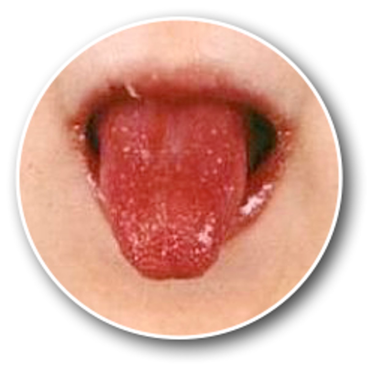 <p>A 3-year-old boy presents to the clinic with his parents due to the manifestations shown above. The parents also report the patient has had a fever of 100.9°F or greater for five consecutive days. Physical examination additionally reveals erythema and edema of the feet and hands, cervical lymphadenopathy, and a polymorphous rash with macular, morbilliform, and targetoid lesions on the trunk and extremities. Which of the following diagnostic tests is most appropriate at this time?</p><p>AElevated erythrocyte sedimentation rate</p><p>BElevated N-terminal moiety of B-type natriuretic peptide</p><p>CMucosal tissue biopsy</p><p>DNo laboratory tests are necessary</p>