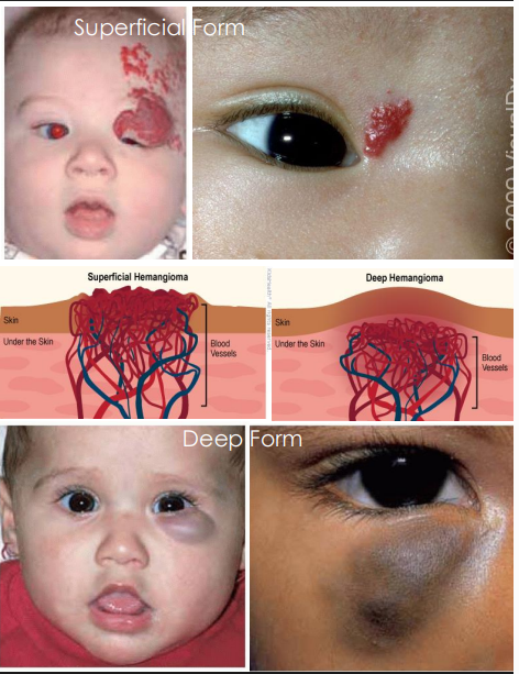 <ol><li><p>Superficial Form: red, flat, lesion that enlarges then completely regresses by age 5 </p></li><li><p>• Deep Form: Subcutaneous and under epidermis, blue-gray color, soft and palpable, IF deep in orbits, can cause proptosis</p></li></ol><p></p>