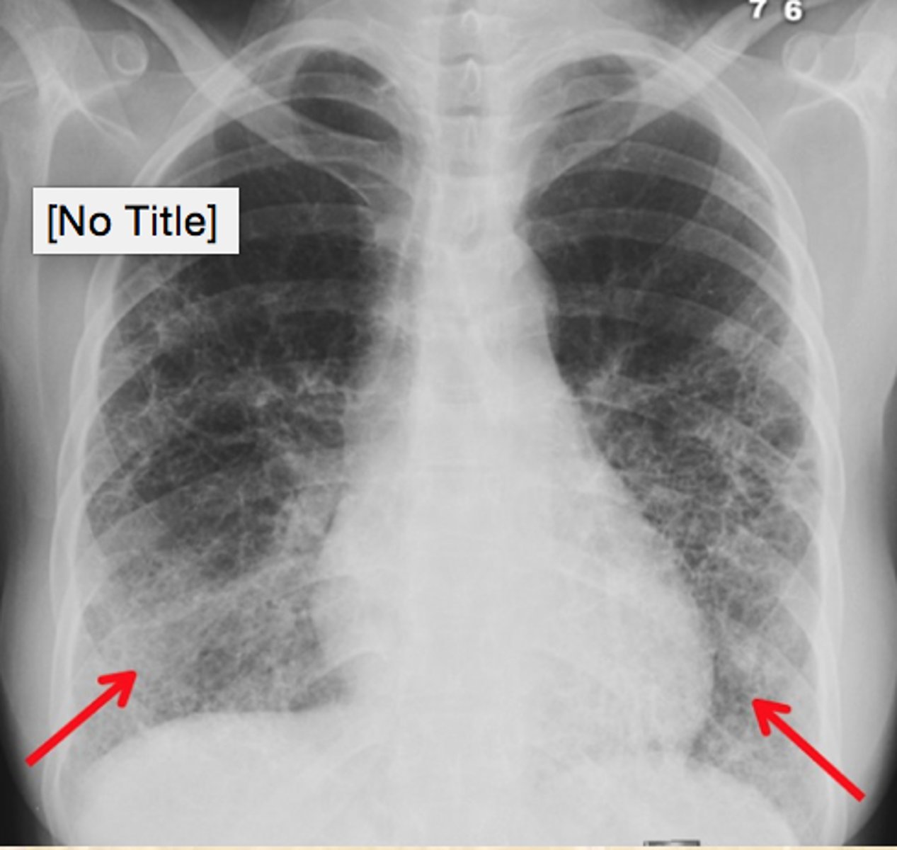 <p>What does this CXR show?</p><p>What term describes the pattern?</p>