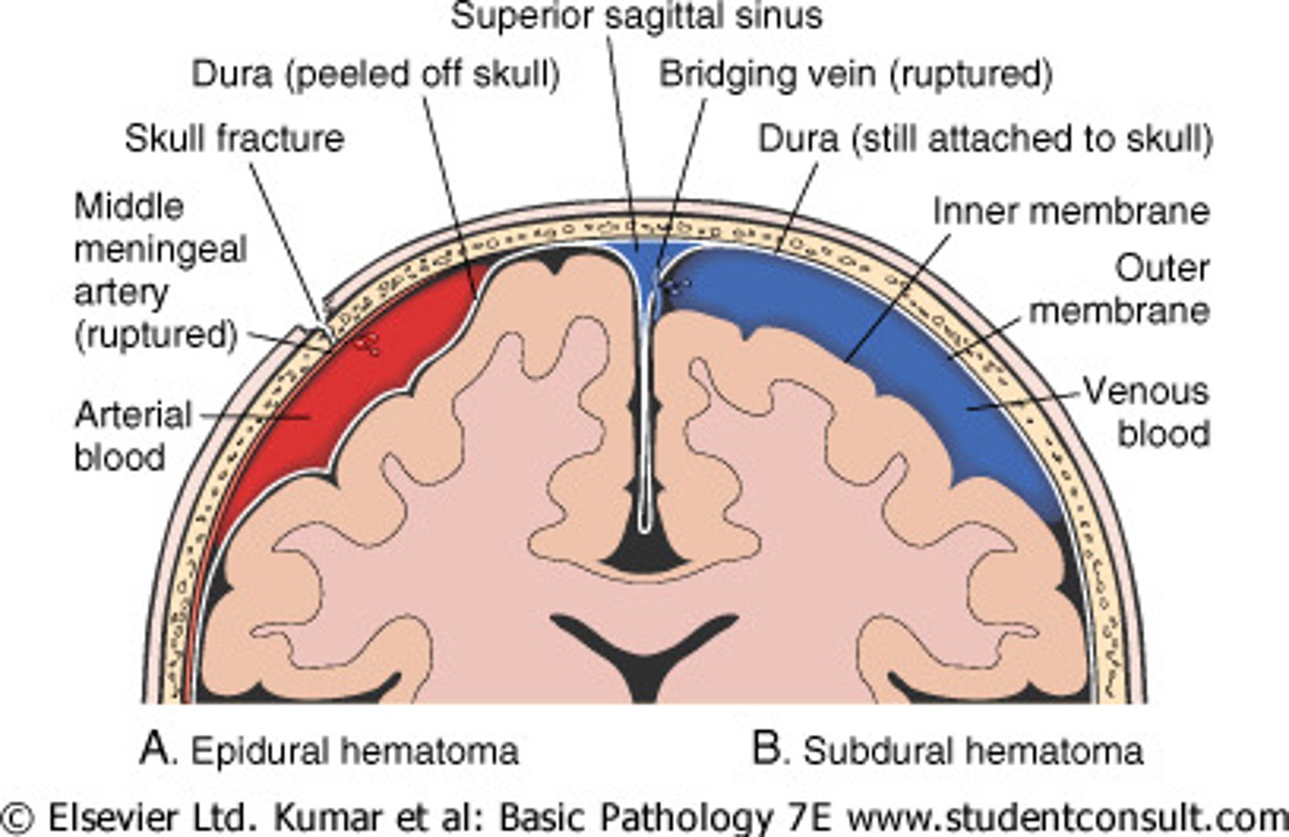 <p>refers to fluid being forced into the region between the dura mater and surrounding bone which are usually attached (pushes periosteum off of bone, not good), such as blood from damage to the meningeal arteries</p>