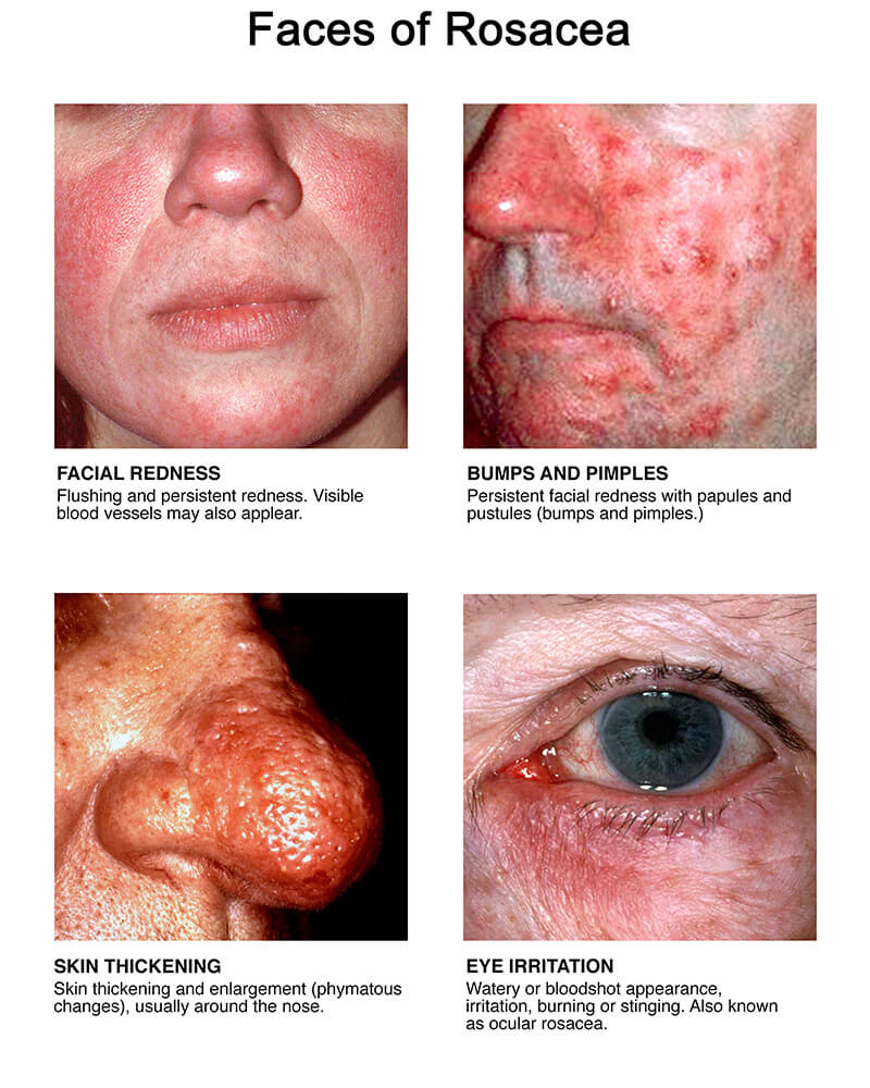 <p>PP: persistent erythema of convex surfaces of face<br><strong>includes nasolabial fold</strong></p><p>E: unknown<br>steroids (too long/strong on face)</p><p>CM:<br>phymatous (nose)<br>ocular (eye)<br>papulopustular (papules/pustules)<br>erythematotelangioetic (flushing)</p><p>DX: biopsy<br>ANA</p><p>TX:</p><p>NP:<br>avoid spicy foods<br>avoid alcohol<br>gentle skin care regimen<br>blood vessels→laser surgery<br>rhinophyma→surgery+CO2 laser</p><p>MX: <br><u>topical:</u><br><strong>1st line: metronidazole</strong><br>azelaic acid<br>sulfacetamide<br>ivermectin</p><p><u>systemic:</u><br>doxycycline 20mg BID<br>doxycycline 40 mg QD</p>