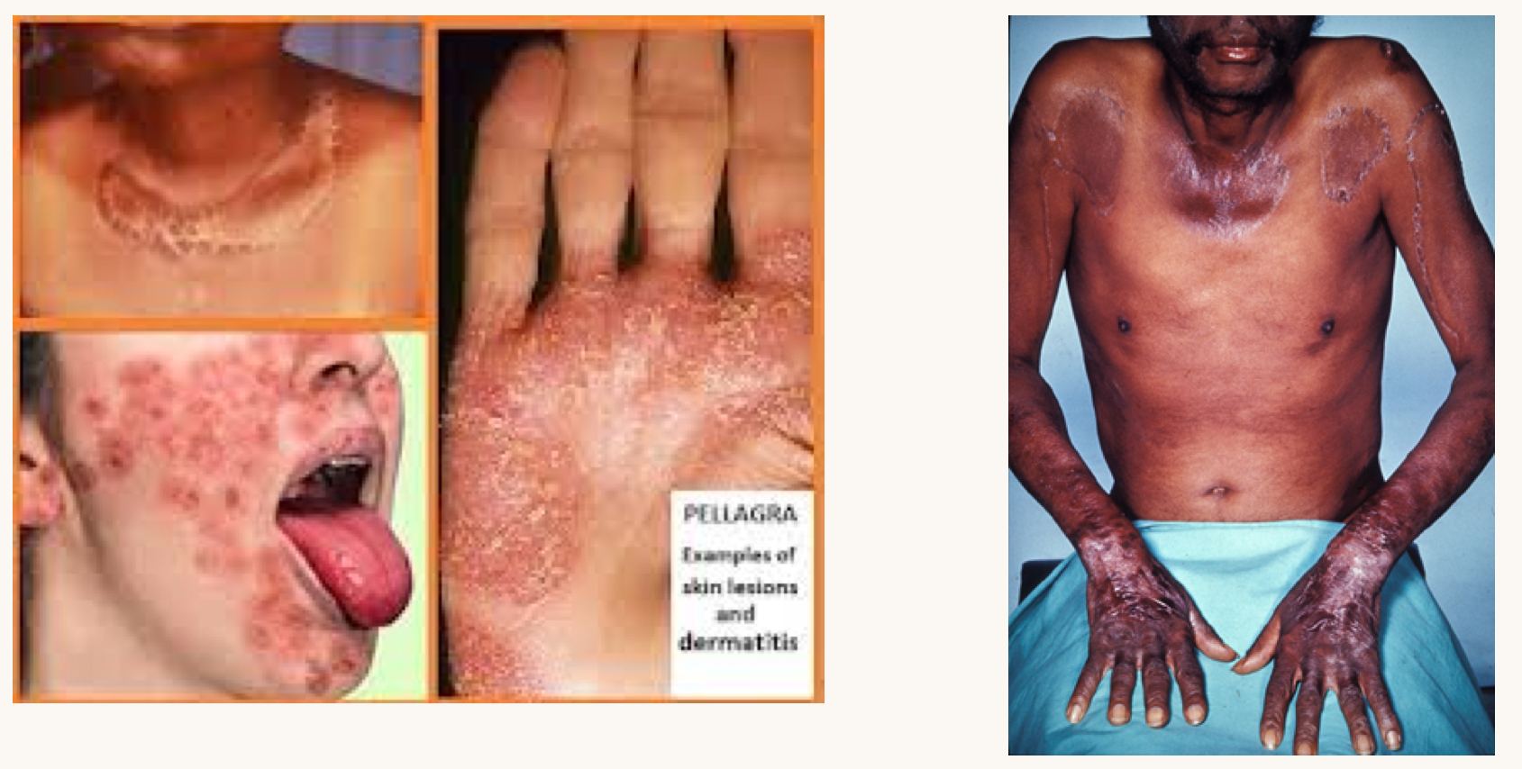 <p>what is this condition and what vitamins is this person likely deficient in?</p>