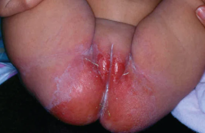 <ul><li><p><strong>Inflammatory reaction of the skin in the diaper area</strong>:</p><ul><li><p>This is a <u>non-immunologic response</u> to a skin irritant.</p></li><li><p>Prolonged exposure to urine and feces may lead to skin breakdown.</p></li><li><p>Diaper wearing increases the skin’s pH, activating fecal enzymes that further contribute to skin maceration.</p></li></ul></li><li><p><strong>Nursing Care</strong>:</p><ul><li><p>Prevention is key to management.</p></li><li><p>Frequent diaper changes.</p></li><li><p>Topical agents such as Vitamin A, D, E; zinc oxide, nystatin, or petroleum.</p></li></ul></li></ul><p></p>