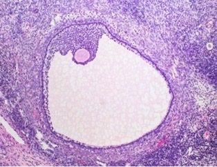 mature or atretic follicle? why?