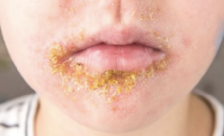 <p>• Streptococcus pyogenes (GAS)</p><p>• Staphylococcus aureus (bullous)</p>