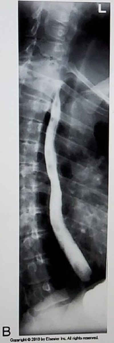 <p>Select the projection used to create this image:</p><p>A. AP, RPO</p><p>B. PA, RAO</p><p>C. AP, supine</p><p>D. Right lateral</p>