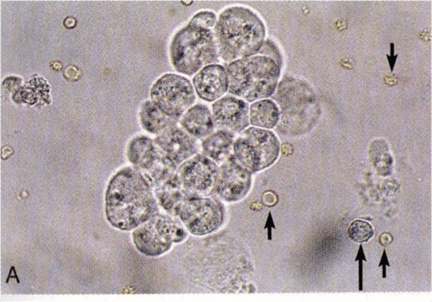 <p>typically observed when there is inflammation or bacterial infections of the renal and urinary tract. The clumping is due to increased mucus in the urine.</p>
