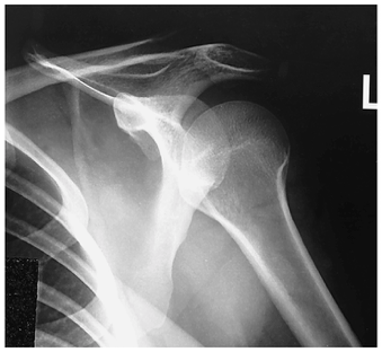 <p>- Epicondyles perpendicular</p><p>- CR 1 inch (2.5 cm) inferior to coracoid process</p><p>- Lesser tubercle profiled medially</p><p>- Scapulohumeral joint centered</p><p>- Proximal humerus, upper scapula, and clavicle visualized</p><p>- Optimal exposure factors</p>