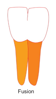 <p>Two tooth buds fusing to form one tooth. Share pulp/root canals</p>