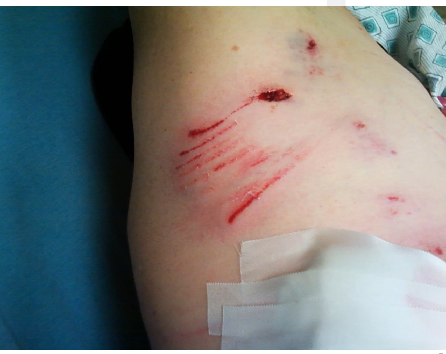 <p>Teeth scraped skin, other tears, red area, treated as a dirty wound </p>