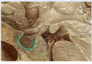 <p>sella turcica (very well protected)</p>