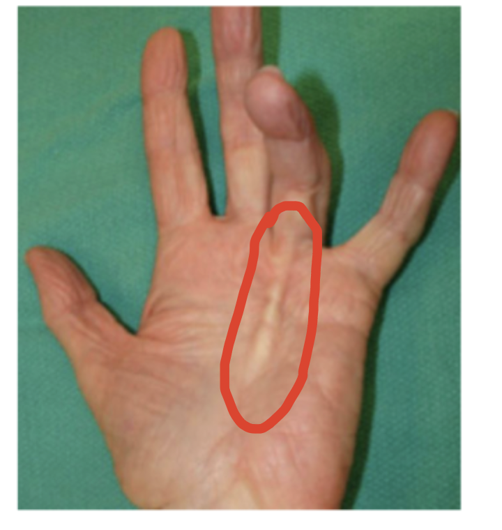 <p>34 y/o male presents to the clinic for hand pain. On physical exam his ring finger is held in flexion and there is decreased ROM at the MCP joint. You are able to palpate a nodular band along the palm of the hand that is tender. What is your op treatment plan?</p>