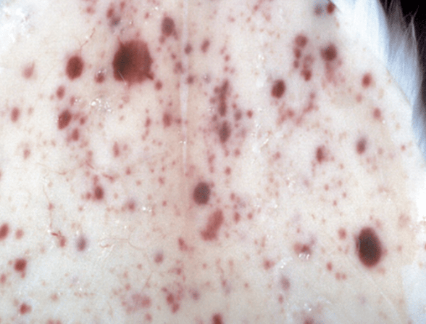 <p>What type of hemorrhages are being shown?</p>