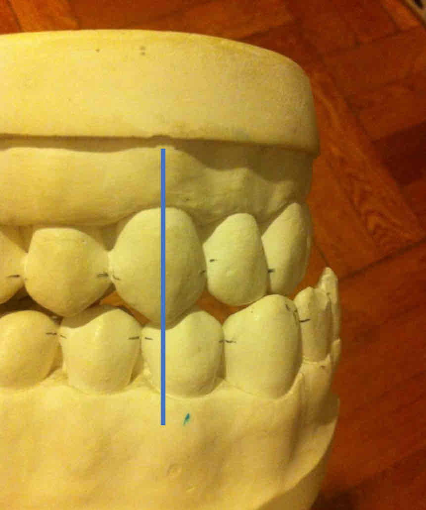 <p>the mesial slope of the max. canine lies behind the distal slope of the mandibular canine</p><ul><li><p>least common : less than 5%</p></li></ul>