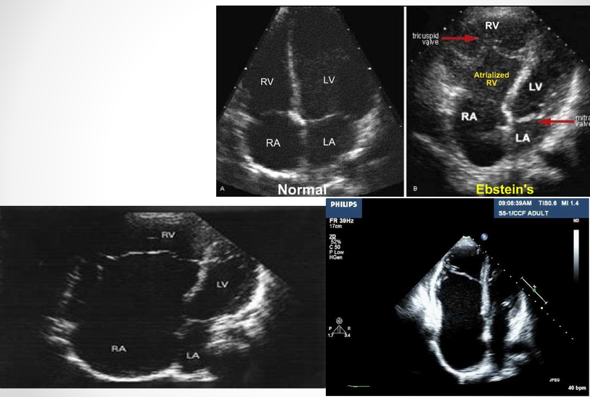 <p>apical displacement of one or more leaflets&nbsp;</p><ul><li><p>insertion of tricuspid leaflet downward into RV (greater than 10mm from mitral valve leaflets) </p></li></ul><p></p>