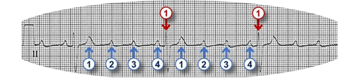<p>High grade AV Block</p>