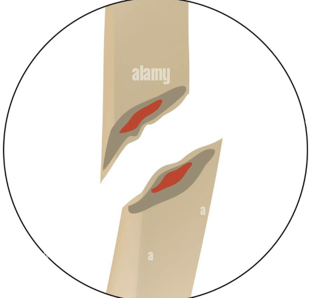 occurs at an angle across the bone, ends are SHARP
