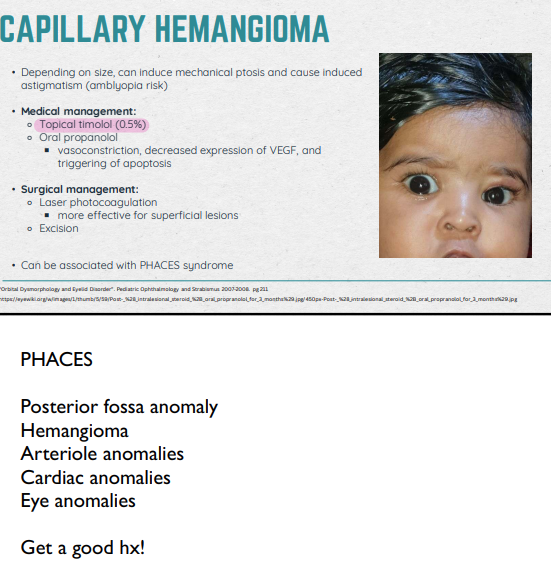 <ul><li><p>Congenital Harmatoma: a benign mass of disorganized tissue native to a particular anatomical location</p></li><li><p>Correct location (vs Choriostoma)</p></li><li><p>Most common periorbital tumor in children (commonly eyebrow or lid); red/purpleish (BV!)</p></li><li><p>Soft and spongey » blanches with pressure</p></li><li><p>Can induce mechanical ptosis and cause induced AST (amblyopia risk)</p></li></ul><p></p>