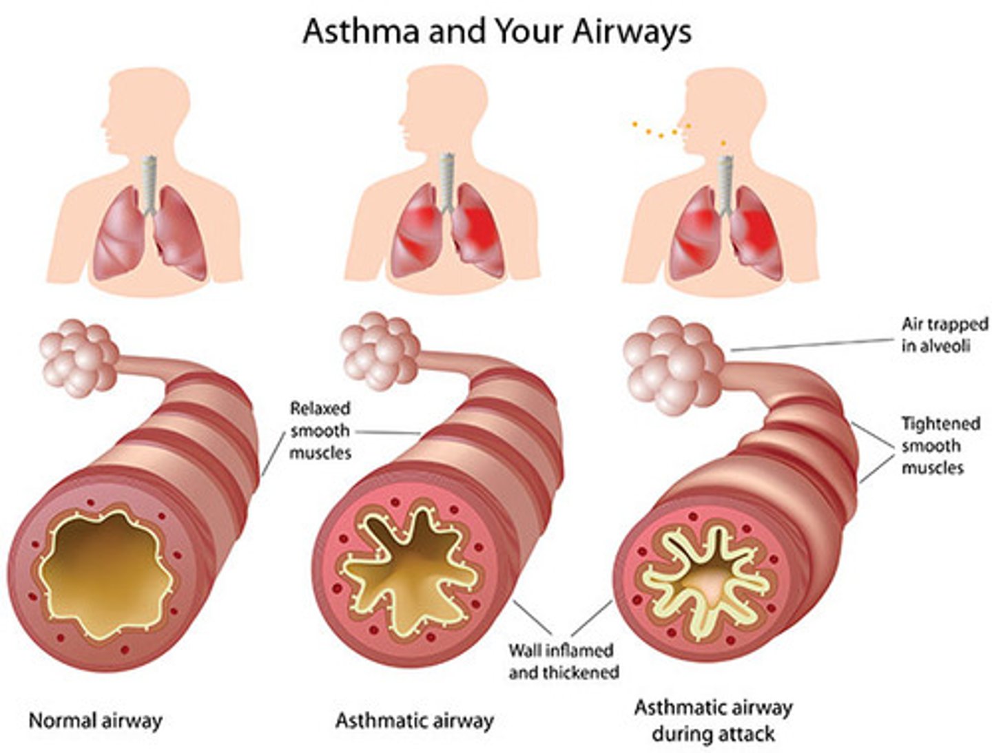 <p>During an asthma attack, the muscle wall contracts, and the lining of the airways becomes swollen and inflamed, causing narrowing of the airways and increased mucous secretions.</p>