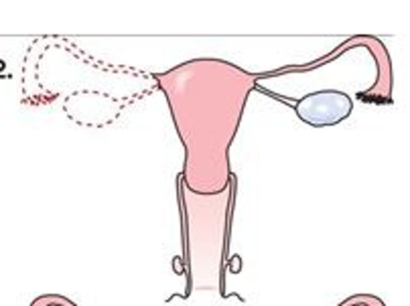 <p>excision of the uterine tube and ovary</p>