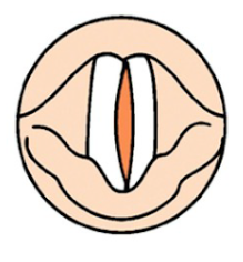 What type of VF closure is this?