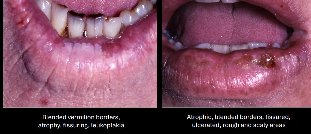 <p>blended vermillion borders, atrophy, fissuring, leukoplakia, ulcerated, rough and scaly area </p>