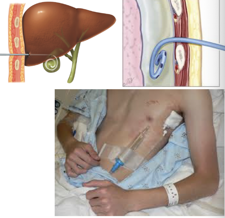 <p><span style="color: blue"><strong>closed, passive</strong></span><strong> percutaneous catheter used to remove body fluid from organ/duct </strong><br><strong>-placed and removed by </strong><span style="color: blue"><strong>interventional radiology</strong></span><strong> ONLY</strong></p><p><em>Indications:</em><br>• <strong>Pleural</strong> <strong>fluid</strong>/<strong>air</strong> <strong>drainage</strong> (with a flutter valve) <br>• <strong>Urine</strong> <strong>from</strong> <strong>kidney</strong> (nephrostomy) <br>• <strong>Bile</strong> from gallbladder (cholecystostomy) <br>• <strong>Intra</strong>-<strong>abdominal</strong> <strong>abscess</strong></p>