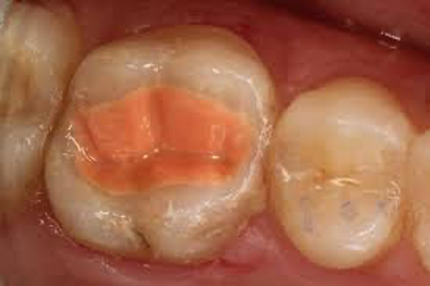 <p>T/F: The GI Fuji Triage (PINK) works well in a moist field &amp; does NOT require isolation</p>