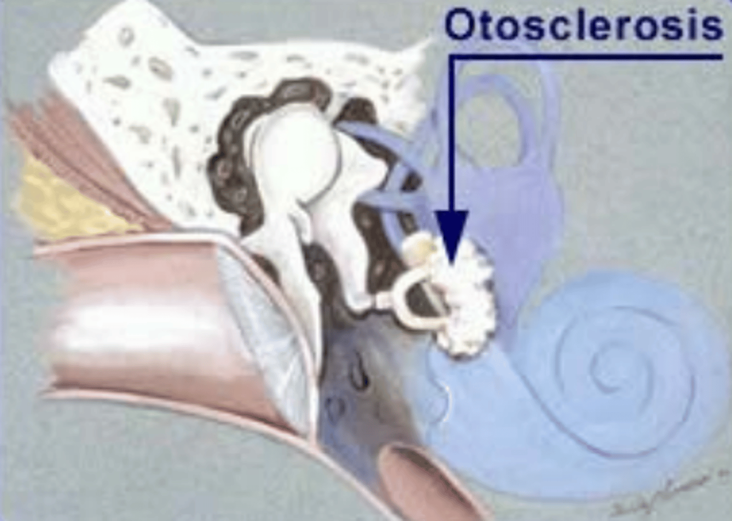 <p>c) Otosclerosis </p>