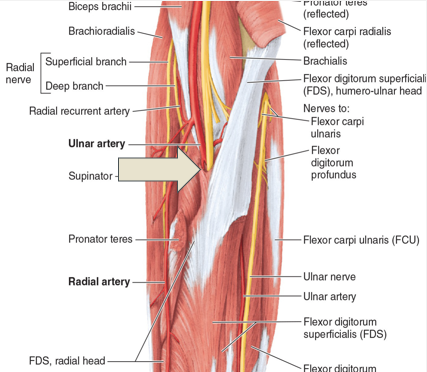 <p>FDS entrapment of median nerve is concomitant w/ Pronator syndrome. resisted FDS performed w/</p>