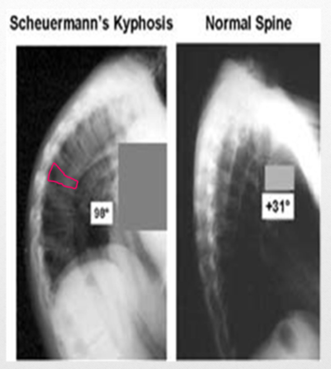 <p>osteochondritis of the thoracic spine that results in wedge-shaped vertebrae</p><p>*growth disturbance of the epiphyseal plates</p><p>**accentuated thoracic kyphosis</p><p>***Schmorl's nodes</p>