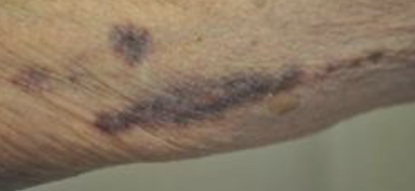 <p>Individual bruising</p>