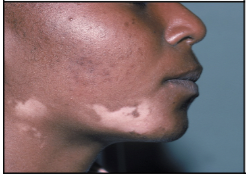 <p>Autoimmune disease in which melanocytes are slowly destroyed and patches of depigmentation appear.</p>