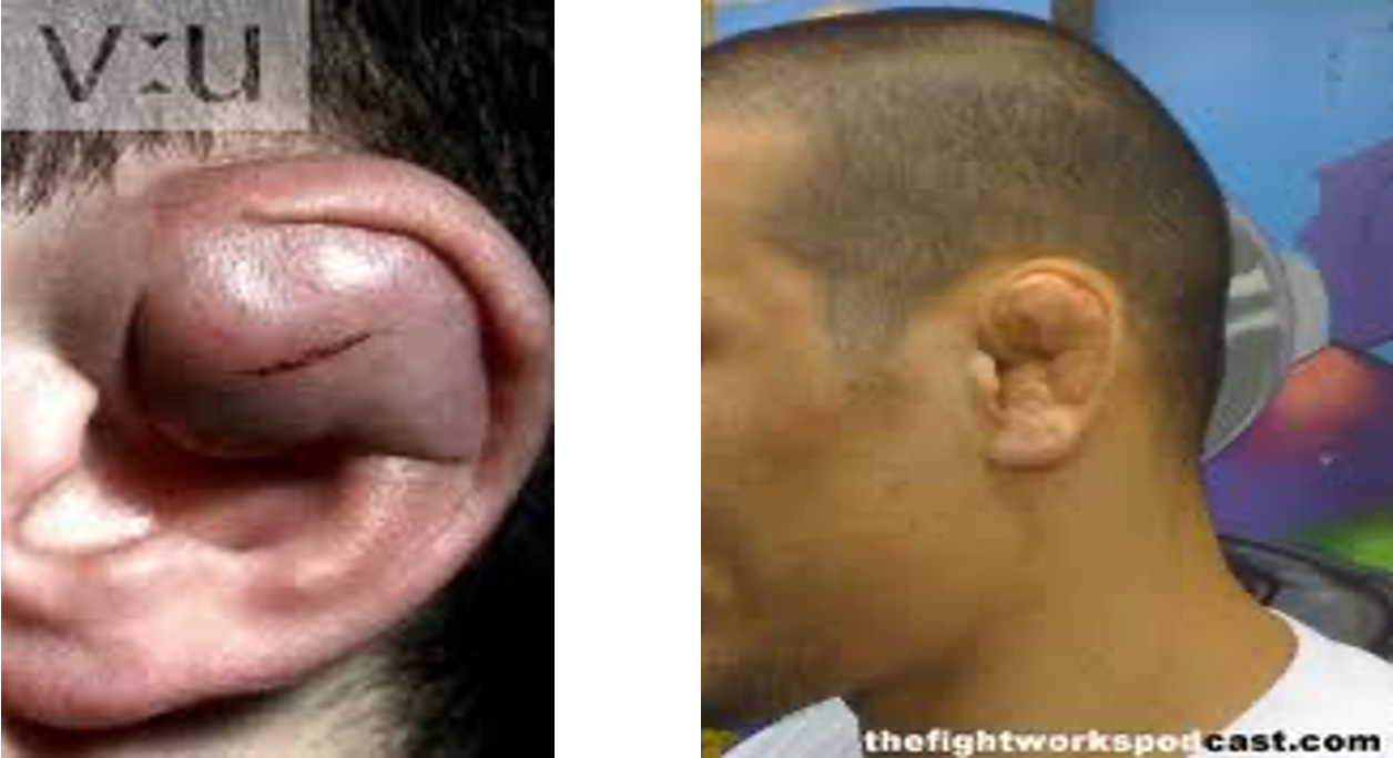 <p>cauliflower ear, canal blockage</p>