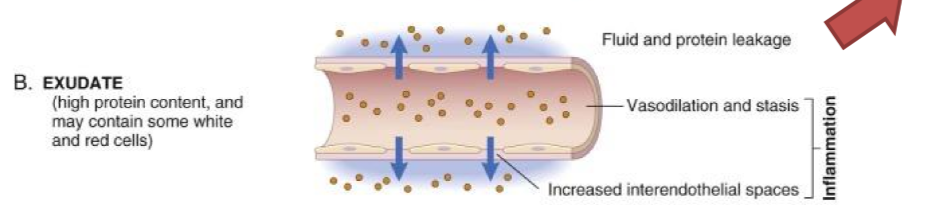 <p>inflammation causes cytokines to be released, resulting in increased vascular permeability, leading to the accumulation of fluid, proteins, and cells in tissues. </p>