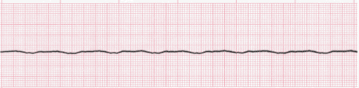 <p>flat line, no pulse; lack of electrical activity</p>