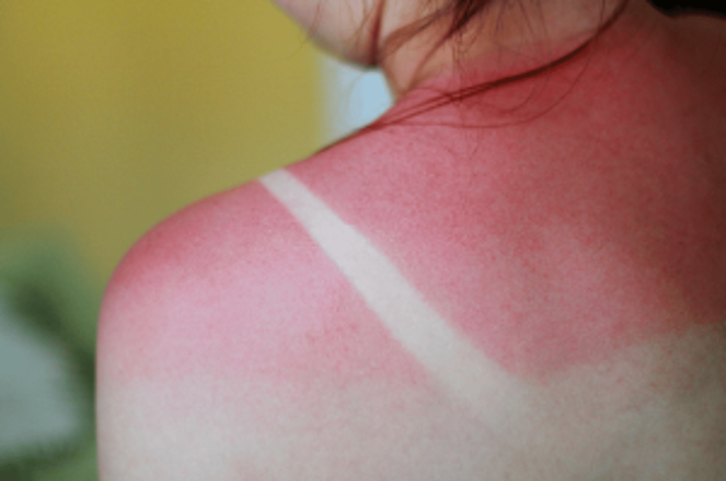 <p>tissue damage and cell death caused by heat, electricity, UV radiation, or chemicals</p>