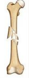 <p>what kind of fracture is this </p>