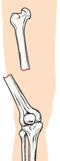 <p>bone breaks in two and is sideways</p>