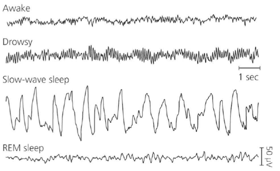 <p>The amplitude of an EEG of a drowsy</p><p>individual is _________(than) an</p><p>individual that is awake.</p><p><span>A. </span>the same as</p><p><span>B. </span>higher</p><p><span>C. </span>lower</p><p><span>D. </span>slower</p><p><span>E. </span>faster</p>