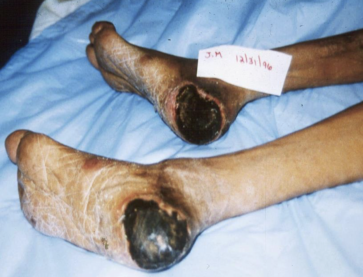 <ul><li><p>Stable Eschar: Dry, adherent, intact without erythema or fluctuance</p></li><li><p>Should NOT be removed or softened </p></li></ul><p></p>