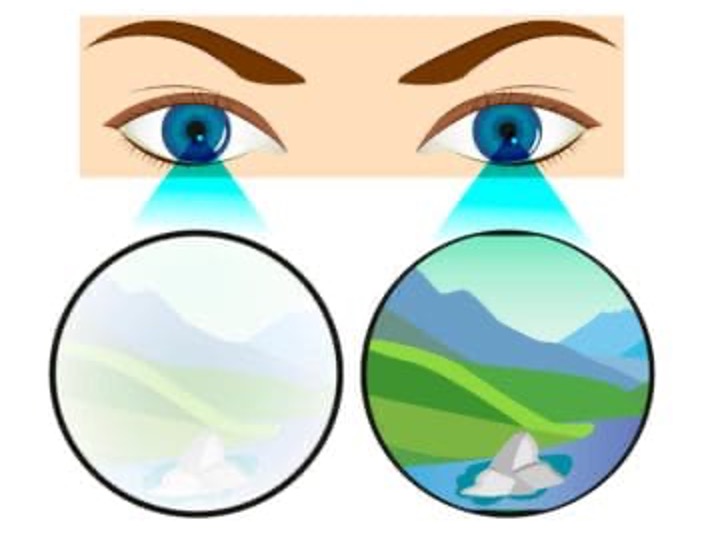 <p>&gt;2 line difference between eyes; most common cause of pediatric visual impairment</p>