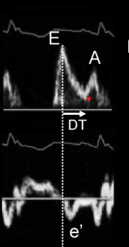 <p>the following mitral inflow and tissue doppler waveforms most likely indicate:</p>