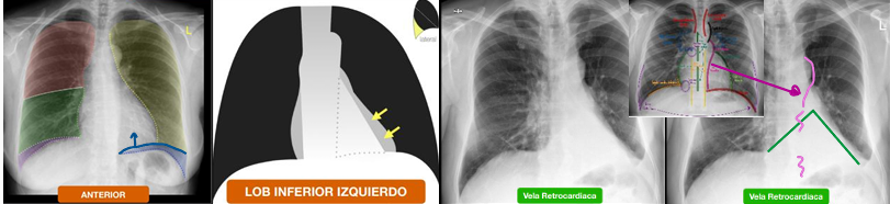 <p>colapso del lóbulo inferior izquierdo</p>