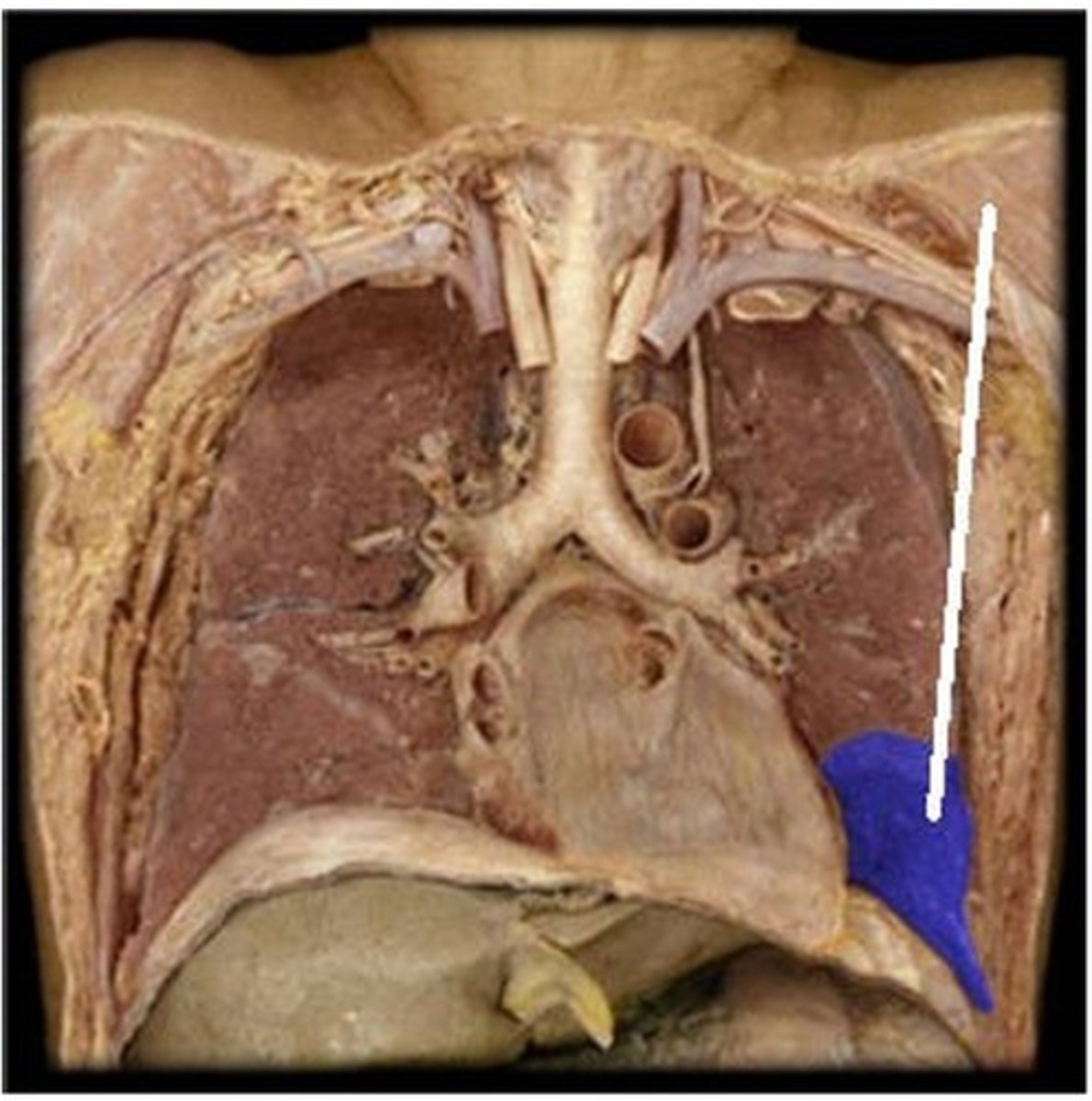 <p>Which structure is highlighted (reference leader line)?</p><p>A) upper lobe of left lung</p><p>B) lower lobe of right lung</p><p>C) upper lobe of right lung</p><p>D) middle lobe of right lung</p><p>E) lower lobe of left lung</p>