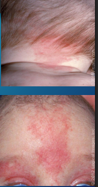 <p><strong>Salmon Patch (Nevus Simplex)</strong></p><p>-Common vascular birthmark&nbsp;</p><p>-Results from _______ of dermal __________</p><p>-Red, ________, macular patches that are commonly found on _____ of neck, eyelids, and glabella&nbsp;</p><p>-Most facial lesions fade by _ y/o, but nuchal lesions may persist through life&nbsp;</p>