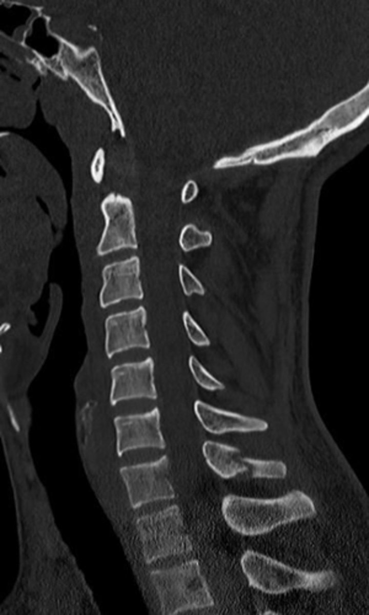 <p>Fracture of C6 or C7 spinous process, relatively innocuous.</p>