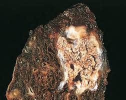 <p>caseous necrosis</p>